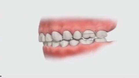 地包牙图片,揭秘牙齿排列的神奇现象